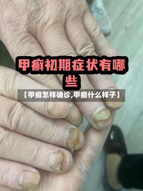 【甲癣怎样确诊,甲癣什么样子】-第2张图片