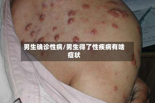男生确诊性病/男生得了性疾病有啥症状
