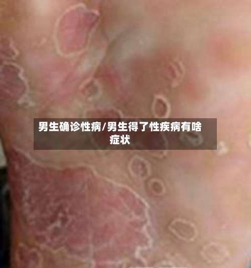 男生确诊性病/男生得了性疾病有啥症状-第2张图片