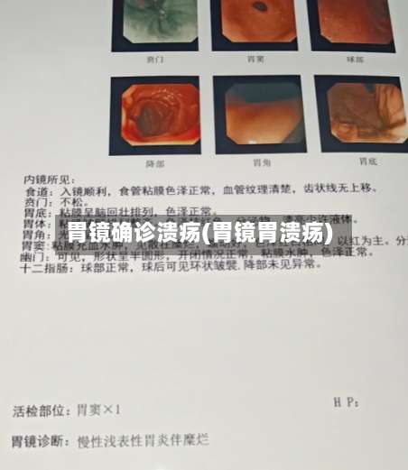 胃镜确诊溃疡(胃镜胃溃疡)-第2张图片