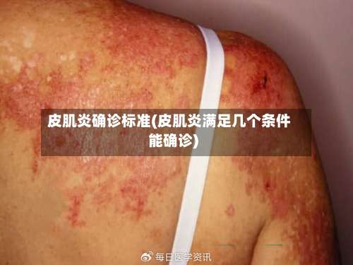 皮肌炎确诊标准(皮肌炎满足几个条件能确诊)