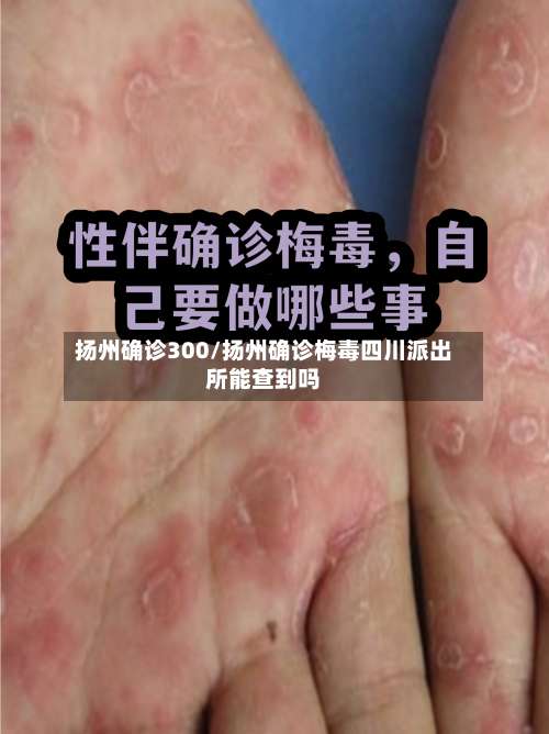 扬州确诊300/扬州确诊梅毒四川派出所能查到吗